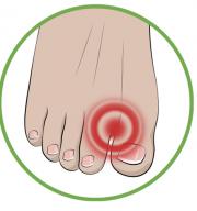 Разделител на пръсти, защита при изкривен палец (hallux valgus)