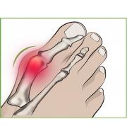 Протектор за става при деформиран палец (hallux valgus) с гел подложка