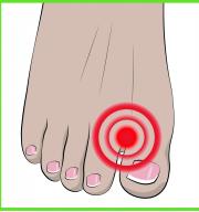 Разделител на пръсти, защита при деформиран палец (hallux valgus) 1 чифт